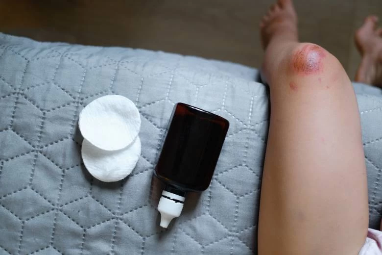 Koji su najbolji preparati za brzo zarastanje rana?