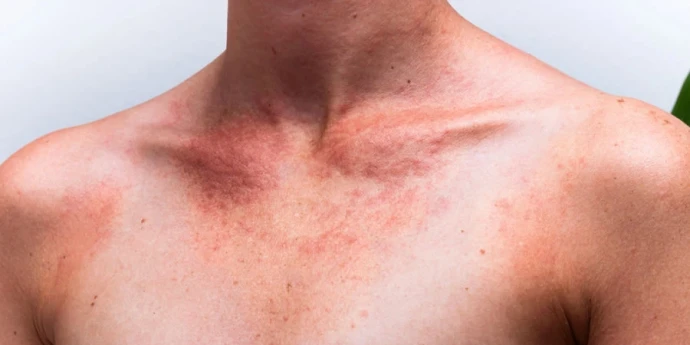 Alergija na sunce, kako se zaštiti od sunca?