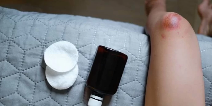 Koji su najbolji preparati za brzo zarastanje rana?