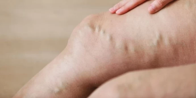 Medicinske čarape za vene - da li pomažu, kako se obuvaju i koliko dugo se nose?